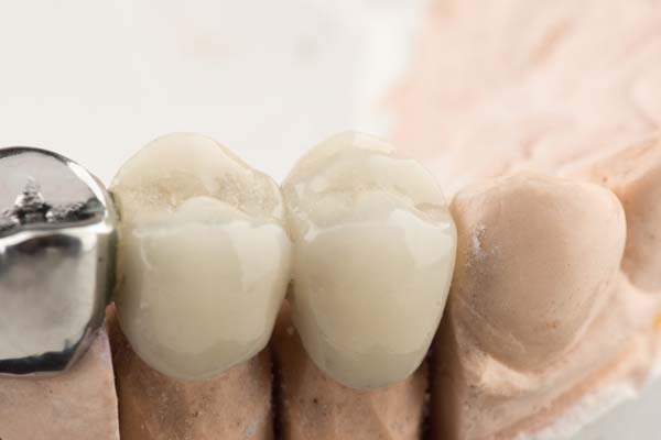 When Would A Dentist Recommend Dental Bridges?