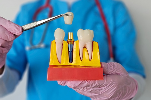 Understanding The Procedure For Dental Implants