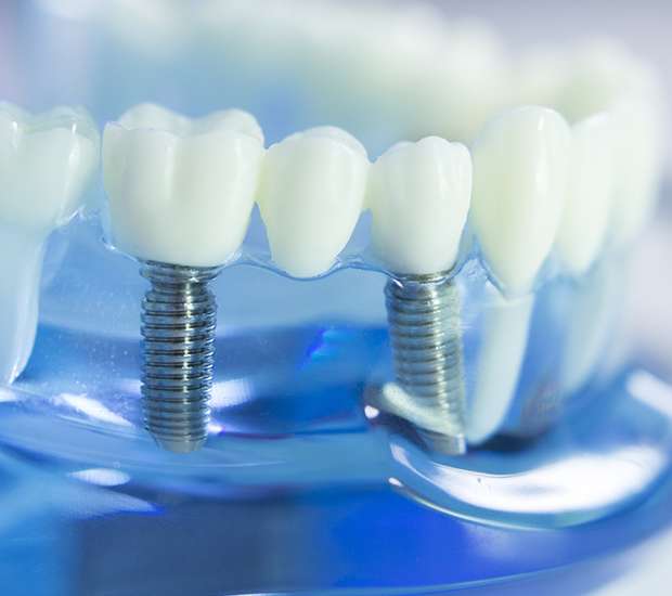 Fort Worth Dental Implants