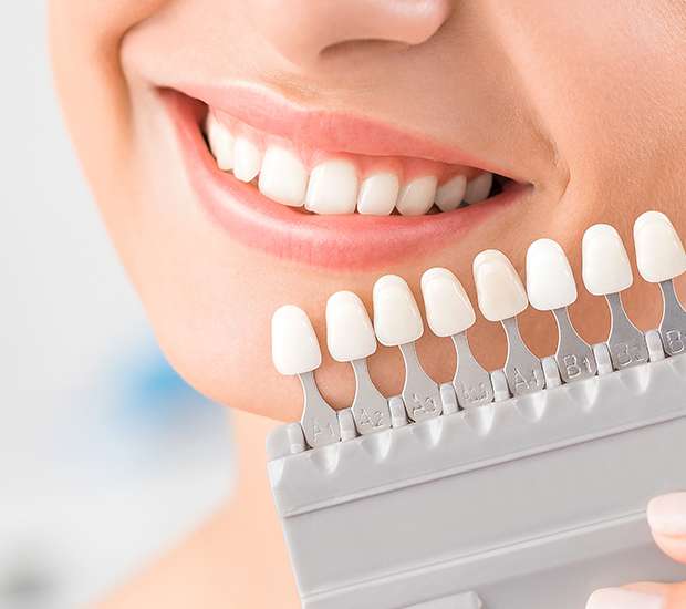 Fort Worth Dental Veneers and Dental Laminates