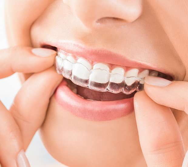 Fort Worth Does Invisalign Really Work