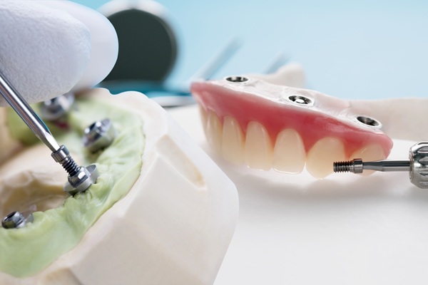 Benefits Of Implant Supported Dentures